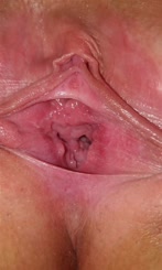 Vagina with a pimple on it